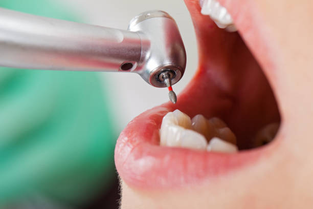 Best Emergency Dental Extractions in Troy Hills, NJ